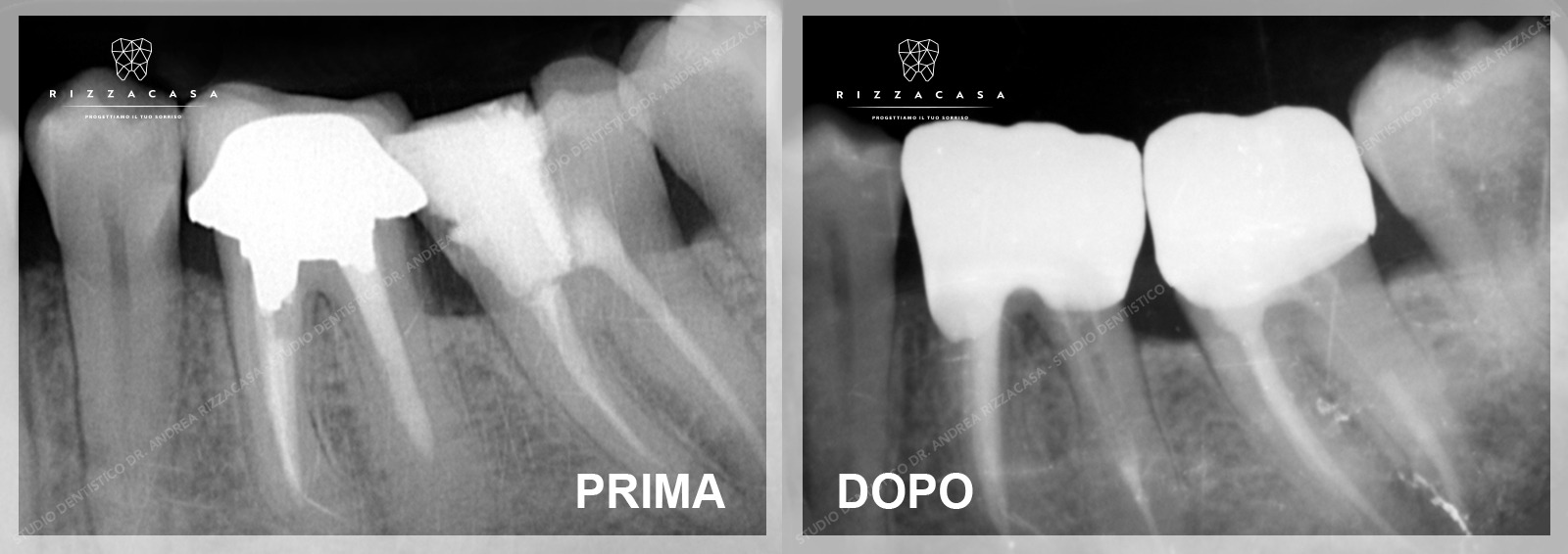 Sonda Esploratrice Per Endodonzia Sonda Dentale DG16 Endo Explorer