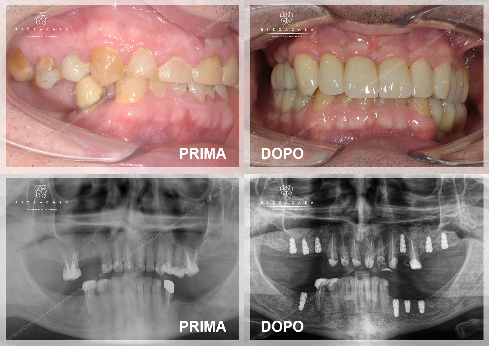 Corone Temporanee Misure 40-54 Corone Dentali Temporanee In - Foto 6