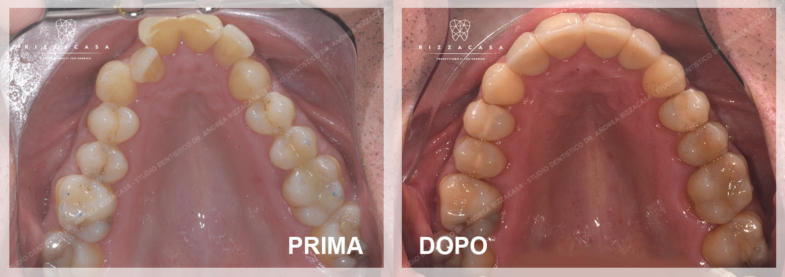 Ortodonzia Adulti: Apparecchio Fisso O Invisibile? | Dentista Verona