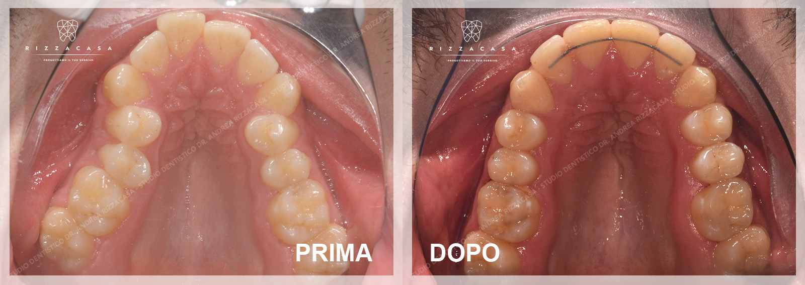 10 Pezzi Dentalmall Lingual Resto Bite Turbos Italia - Foto 8