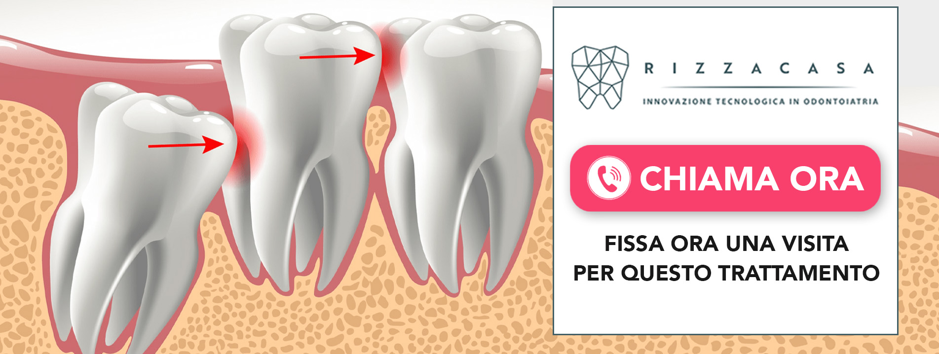 trattamento-denti-inclusi Vedano al Lambro (MB)